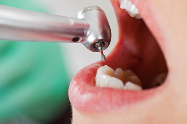 Best Urgent Tooth Repair  in Murphys, CA